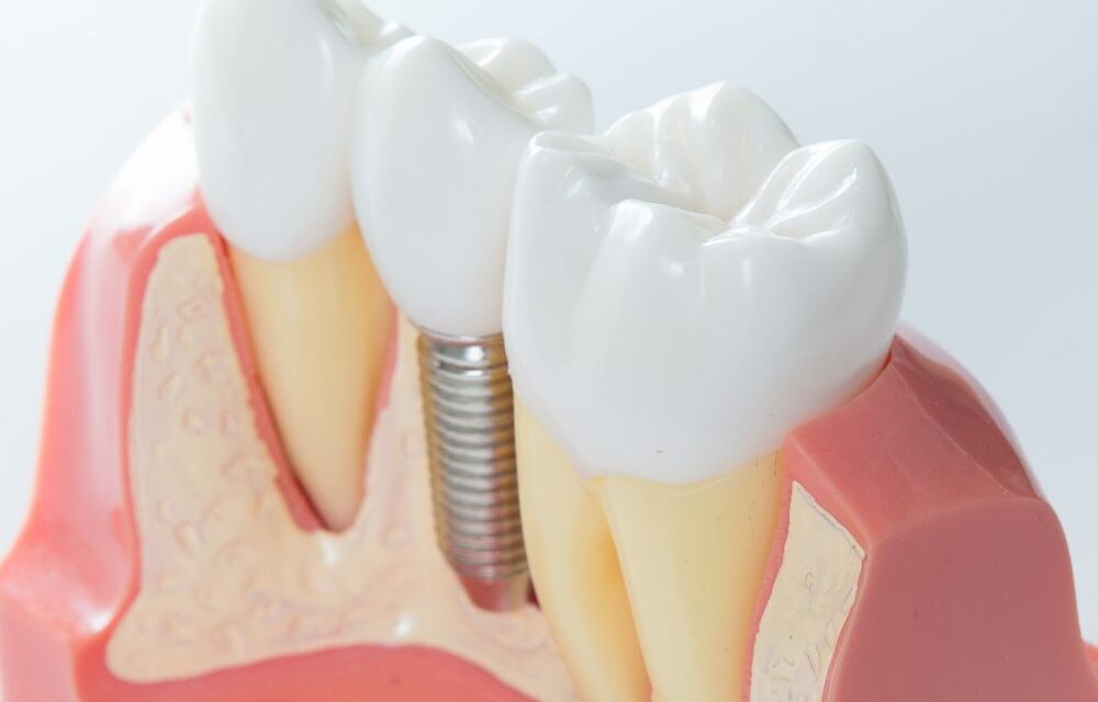 Implantologia dentale: come gli impianti dentali trasformano il sorriso