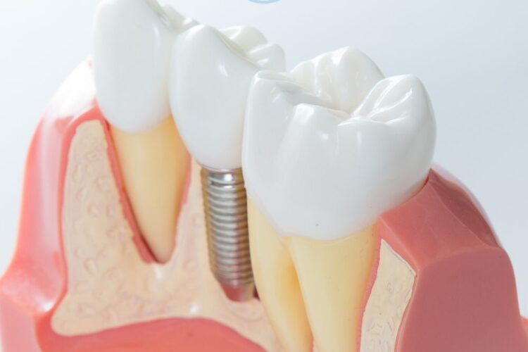 Implantologia dentale: come gli impianti dentali trasformano il sorriso